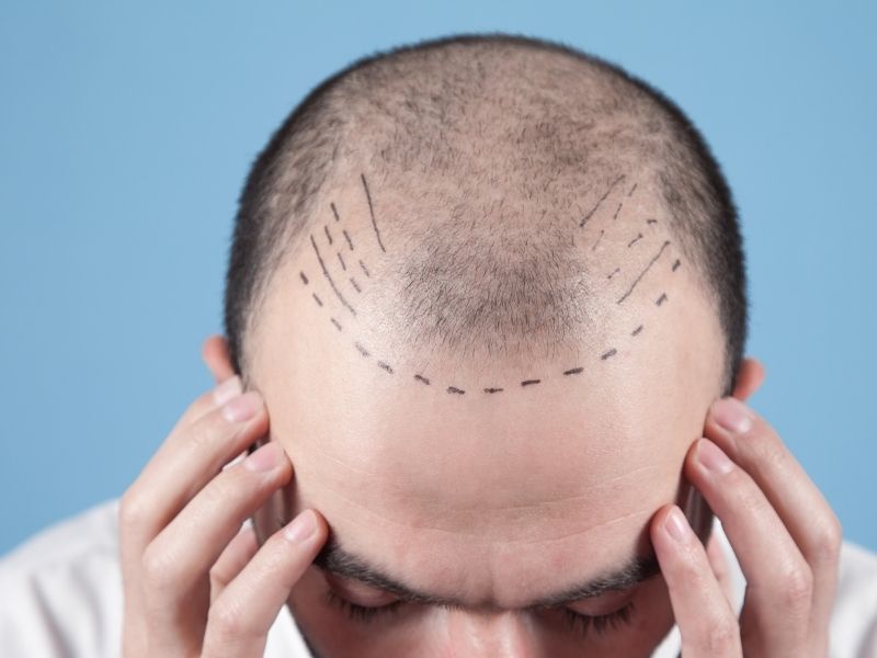 東京 植毛 クリニック